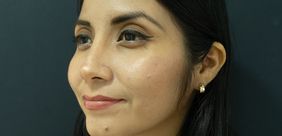 rinoplastia ultrasonica lima