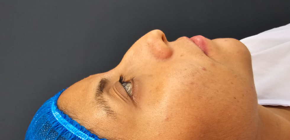 rinoplastia ultrasonica dr guanilo