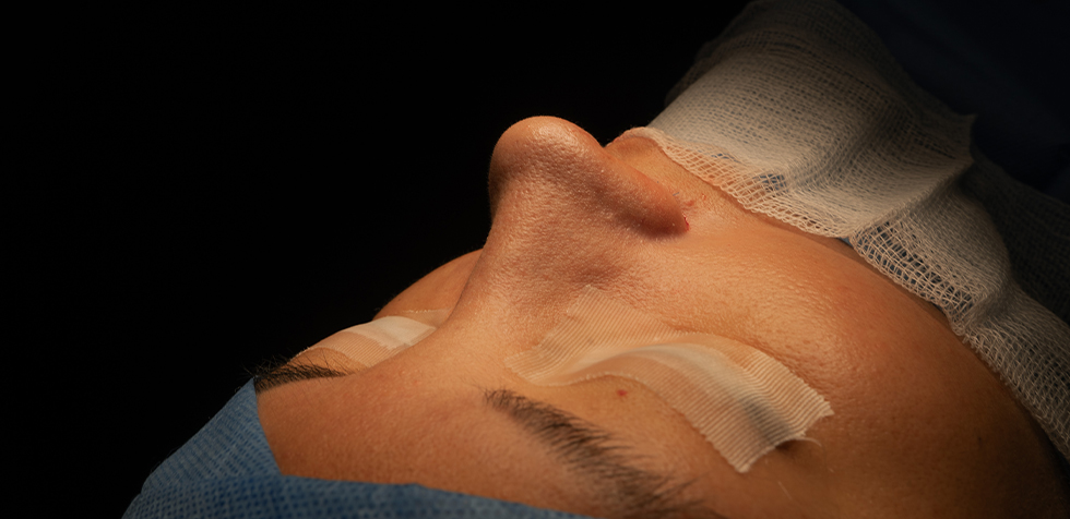evita fibrosis en una rinoplastia