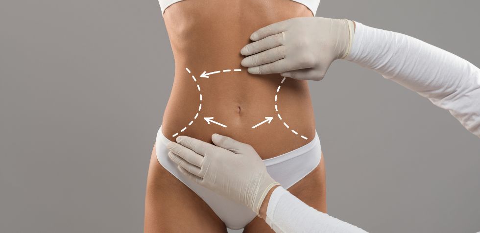 En este artículo conocerás qué es la lipoescultura, para qué sirve y cuáles son los cuidados que debes tener después de la operación.