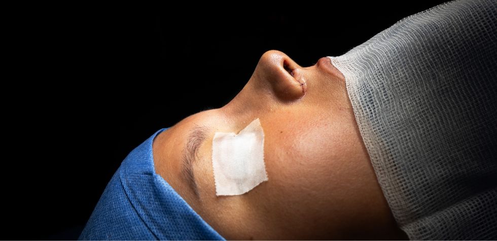¿Se puede deformar la nariz después de una rinoplastia? Conoce los mitos y realidades de los resultados postoperatorios de una rinoplastia.